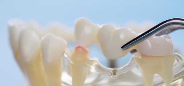 Repairing Damaged Teeth